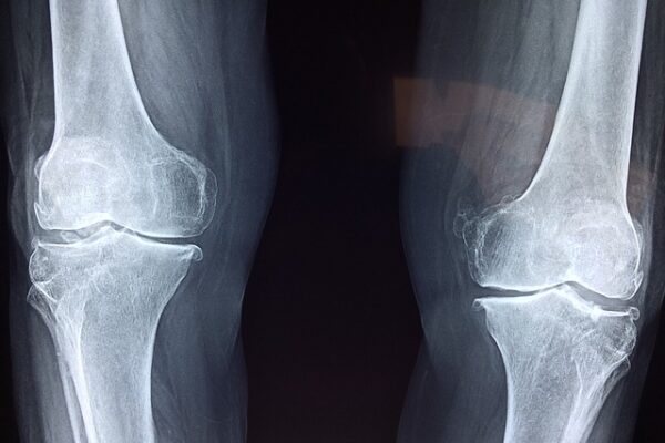 Protesi ginocchio: i vantaggi della chirurgia mini invasiva